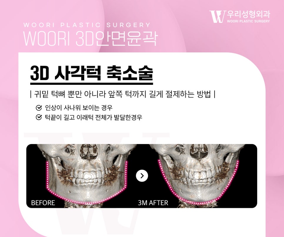 안면윤곽수술 구조 이해하기, 종류부터 주의사항 관련 이미지 2