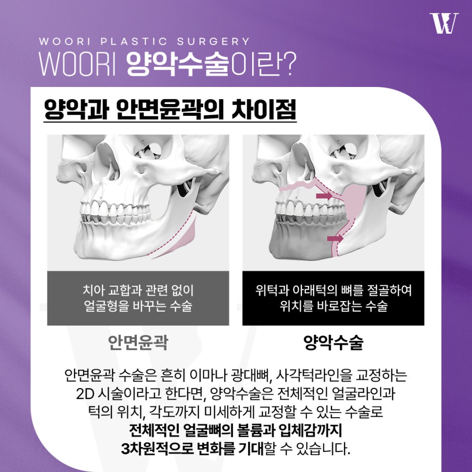 When Is Double Jaw Surgery Needed for Facial Asymmetry? image 2