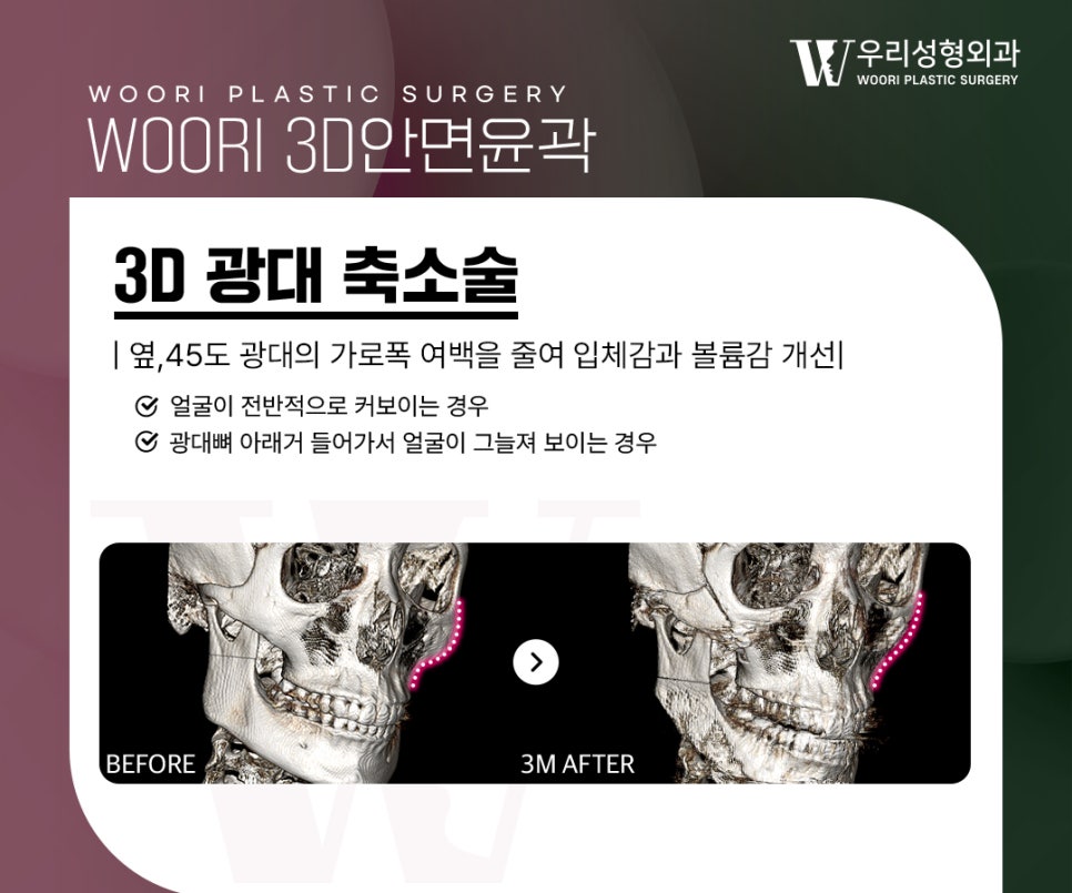 안면윤곽수술 얼굴형이 강해보이는 이유는? 관련 이미지 2