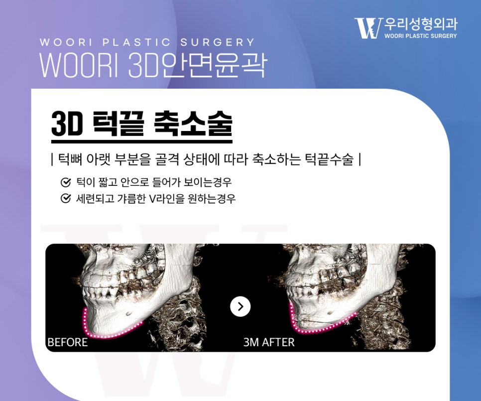 Why Are Cheekbones, Square Jaw, and Chin Often Treated Together in Facial Contouring Surgery? image 4