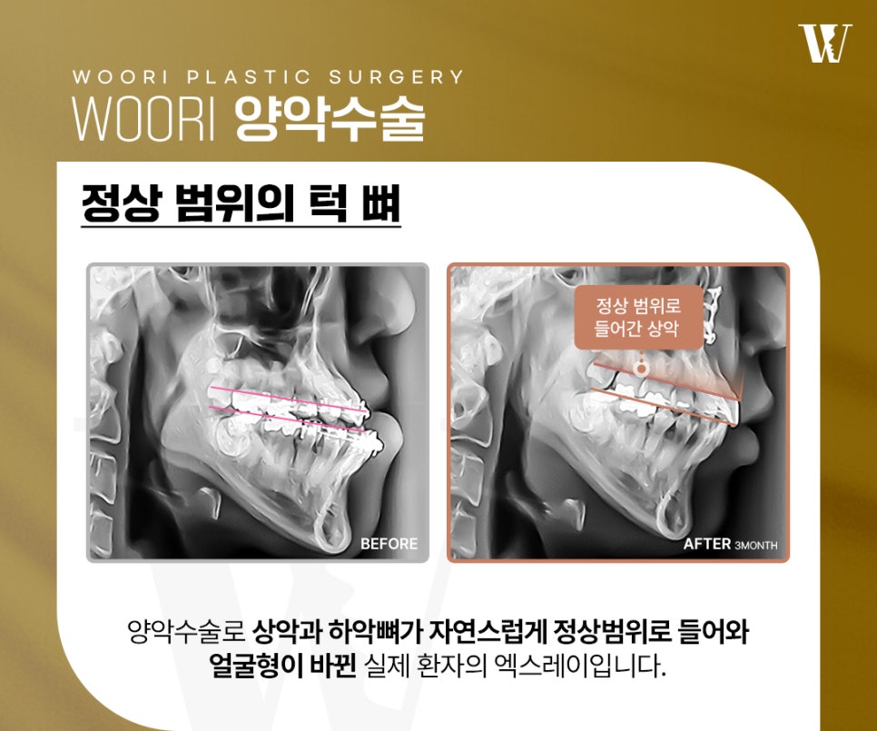 양악수술비용 어떤 부분에서 차이가 생길까? 관련 이미지 3