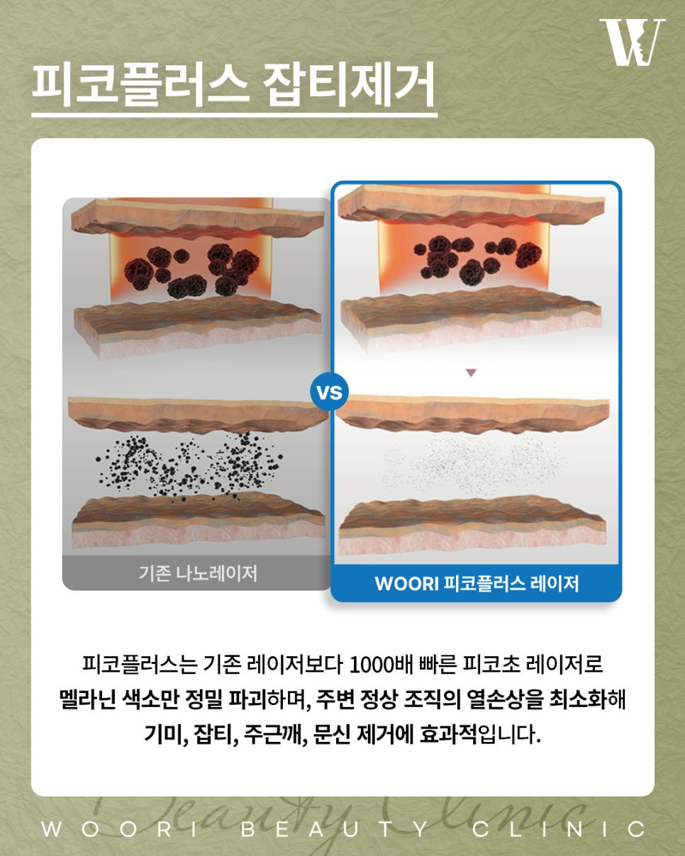 기미제거레이저 한 번에 없어지지 않는 이유는? 관련 이미지 3