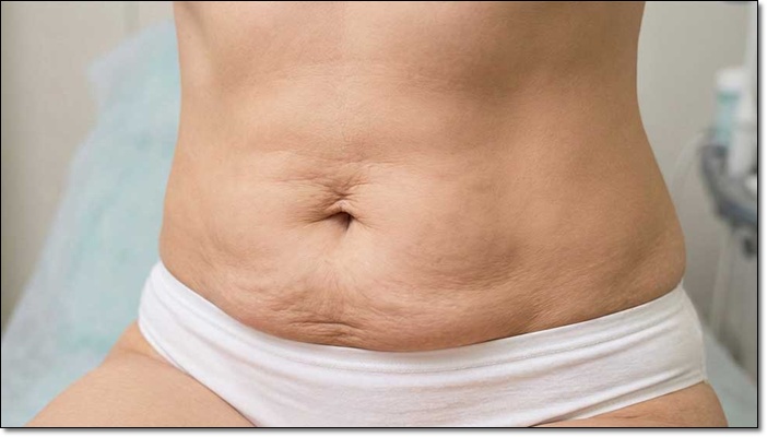 복부거상술 미니복부거상 차이 정리 관련 이미지 4