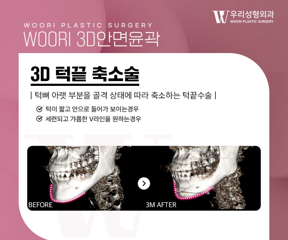 안면윤곽 수술 어떤 차이가 있을까 관련 이미지 4