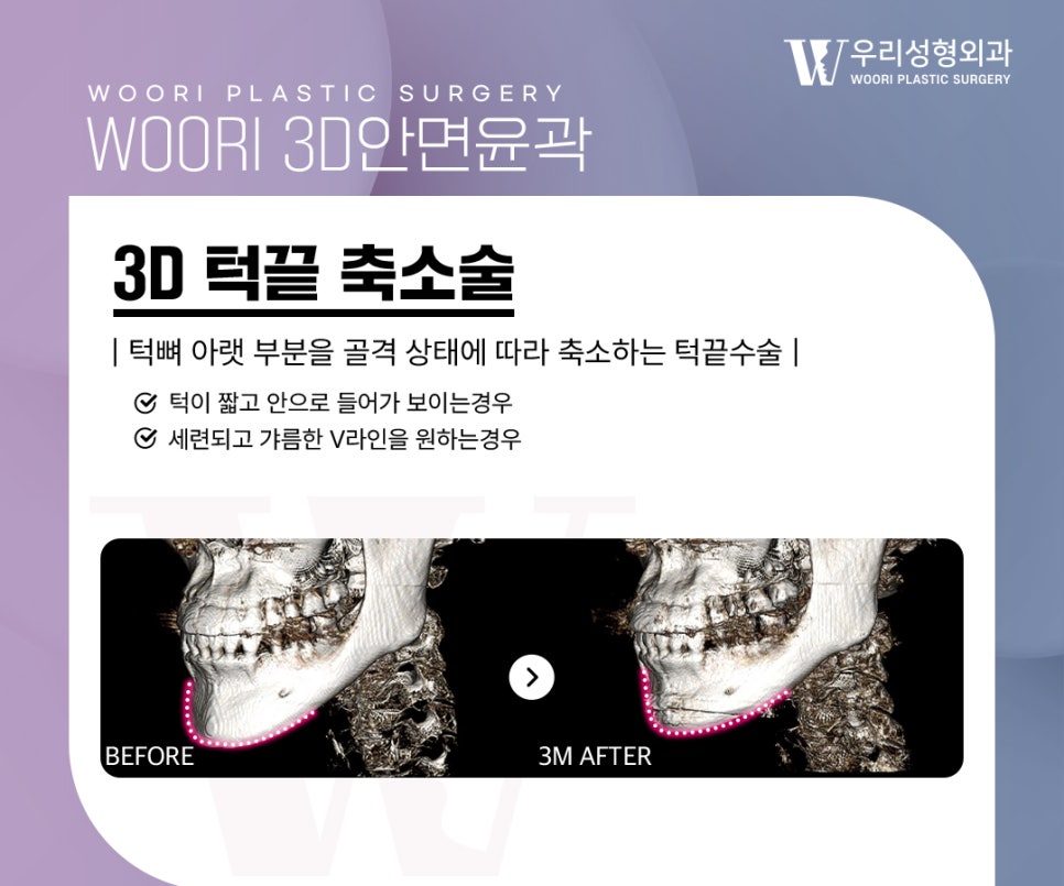 턱끝수술 안면윤곽 3종과 함께 하는 이유는 무엇일까? 관련 이미지 4