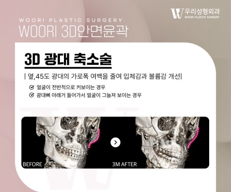 윤곽수술 사각턱·광대·턱끝을 함께 살펴보기 관련 이미지 4