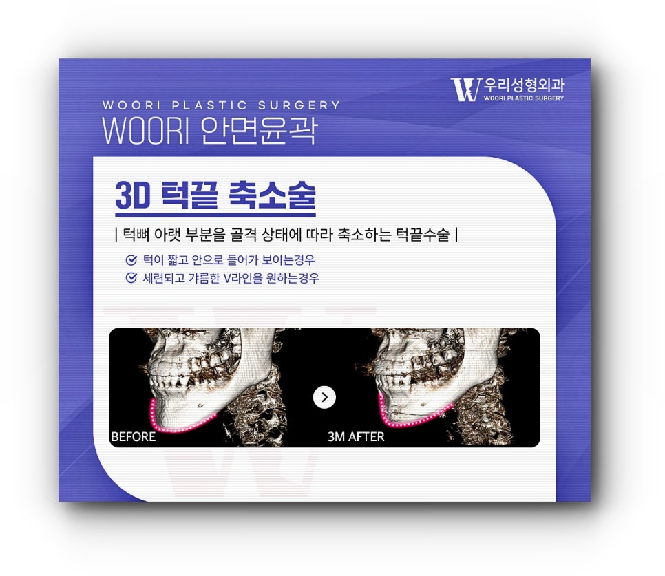 안면윤곽 3종 얼굴형에 큰 변화를 관련 이미지 5