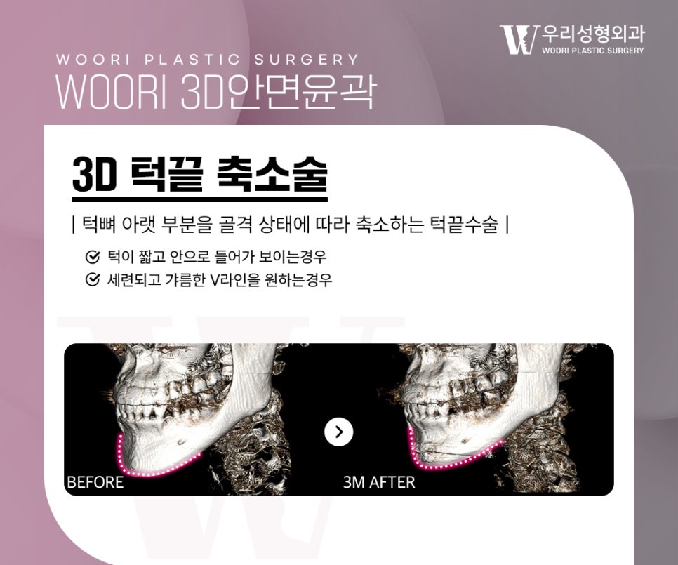 안면윤곽수술, 얼굴형을 정리하는 방법은? 관련 이미지 5