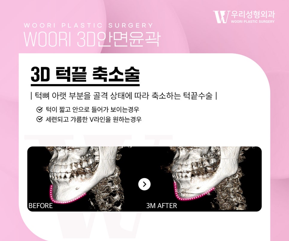 안면윤곽수술 구조 이해하기, 종류부터 주의사항 관련 이미지 4