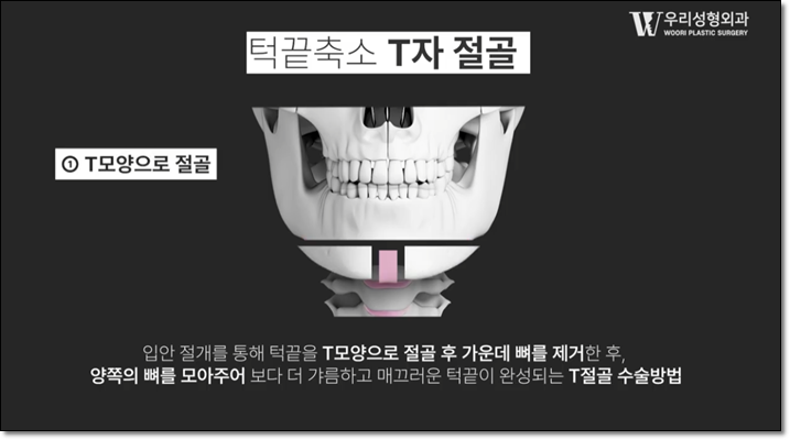턱끝축소술 조화롭게 디자인 하려면 관련 이미지 3