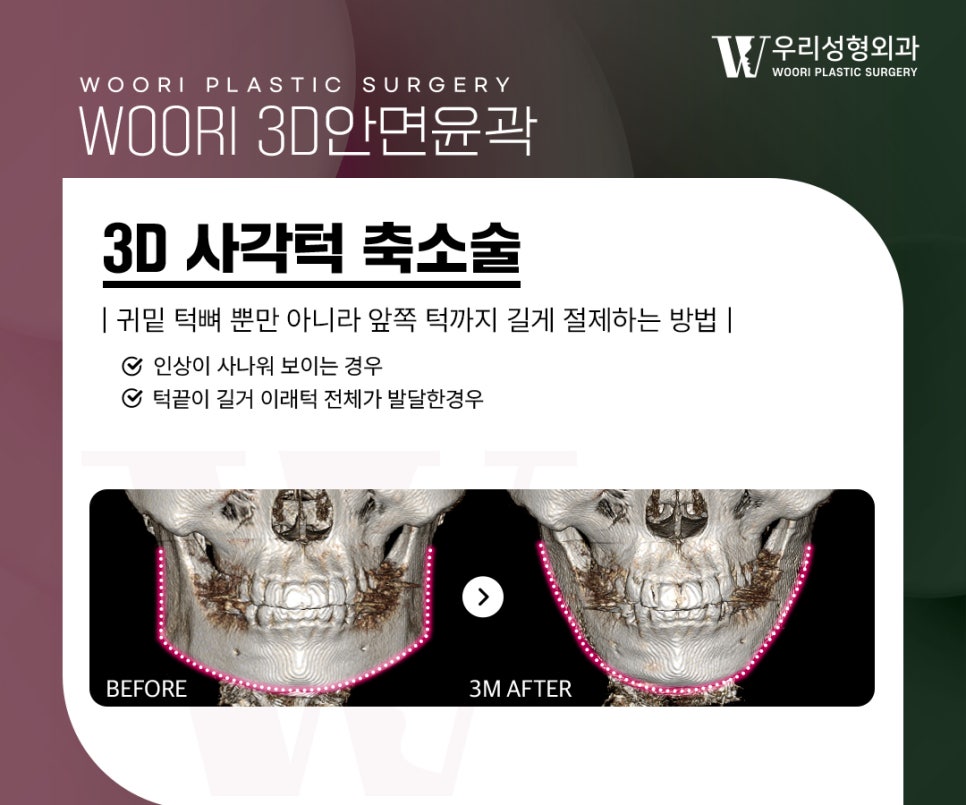 안면윤곽수술 얼굴형이 강해보이는 이유는? 관련 이미지 3