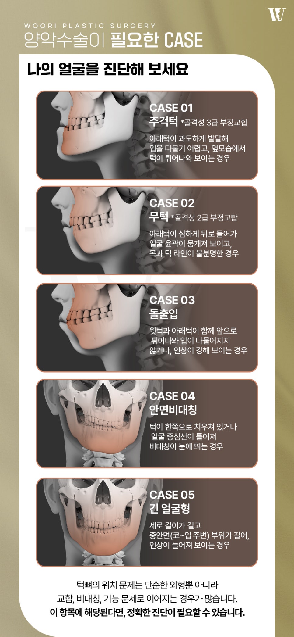 양악후기 주걱턱과 긴 얼굴은 수술 후 어떻게 달라질까요? 관련 이미지 2