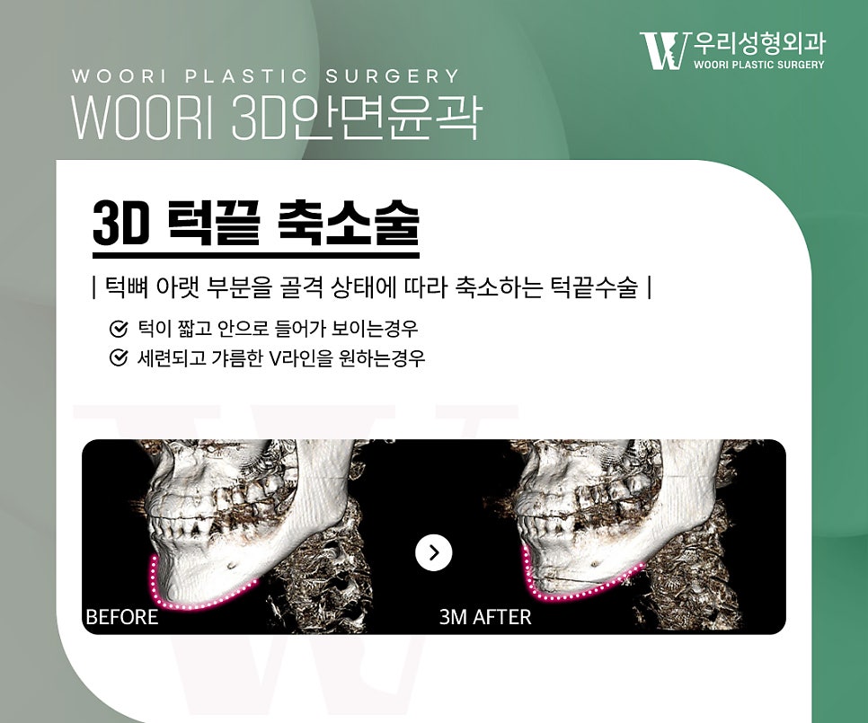 Why Does Facial Width Decrease After Contouring Surgery? image 4