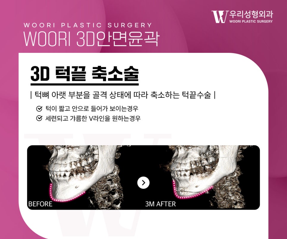 옆광대축소 후 자연스러운 얼굴라인을 만들려면? 관련 이미지 4