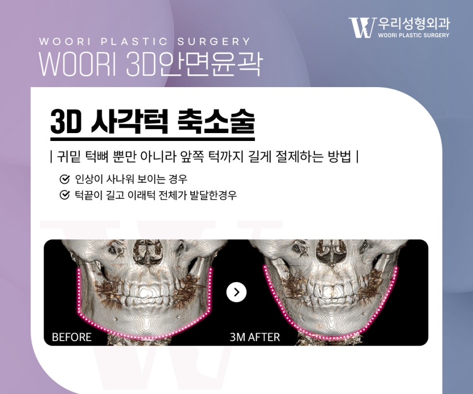 턱끝수술 안면윤곽 3종과 함께 하는 이유는 무엇일까? 관련 이미지 3