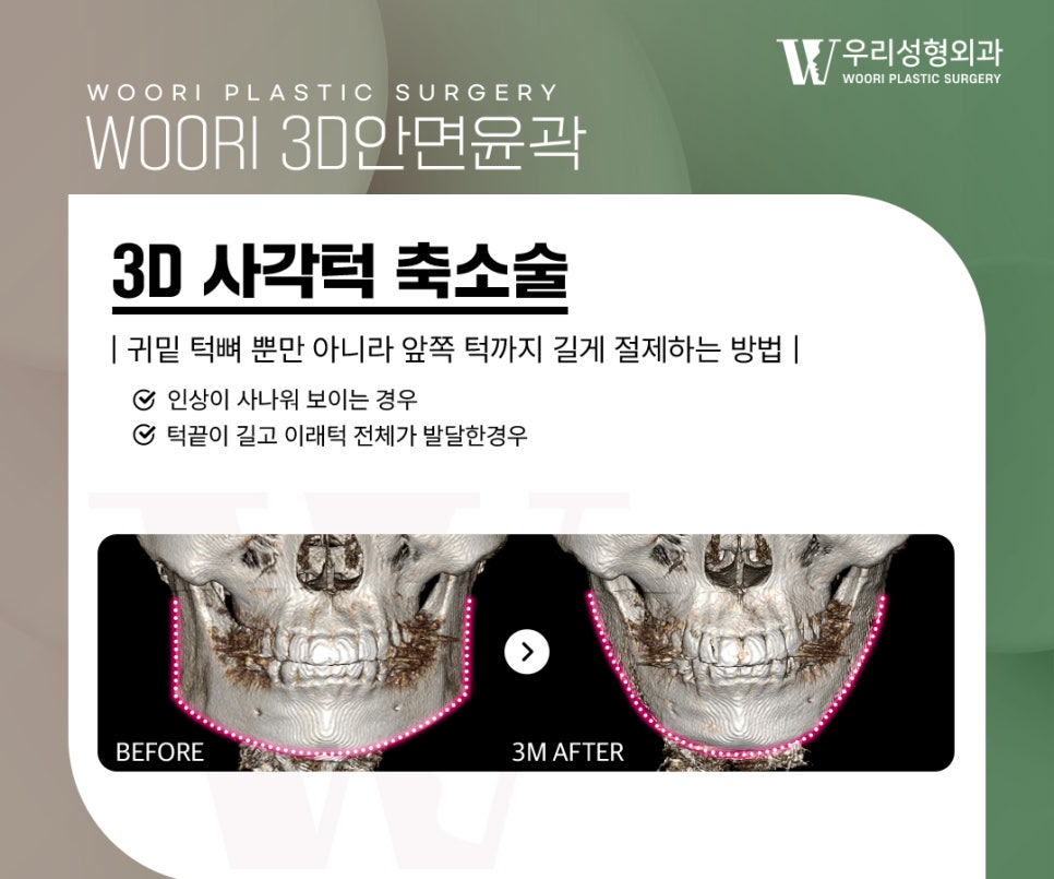 안면윤곽수술 이런 얼굴형이라면 고려해볼 수 있어요 관련 이미지 2