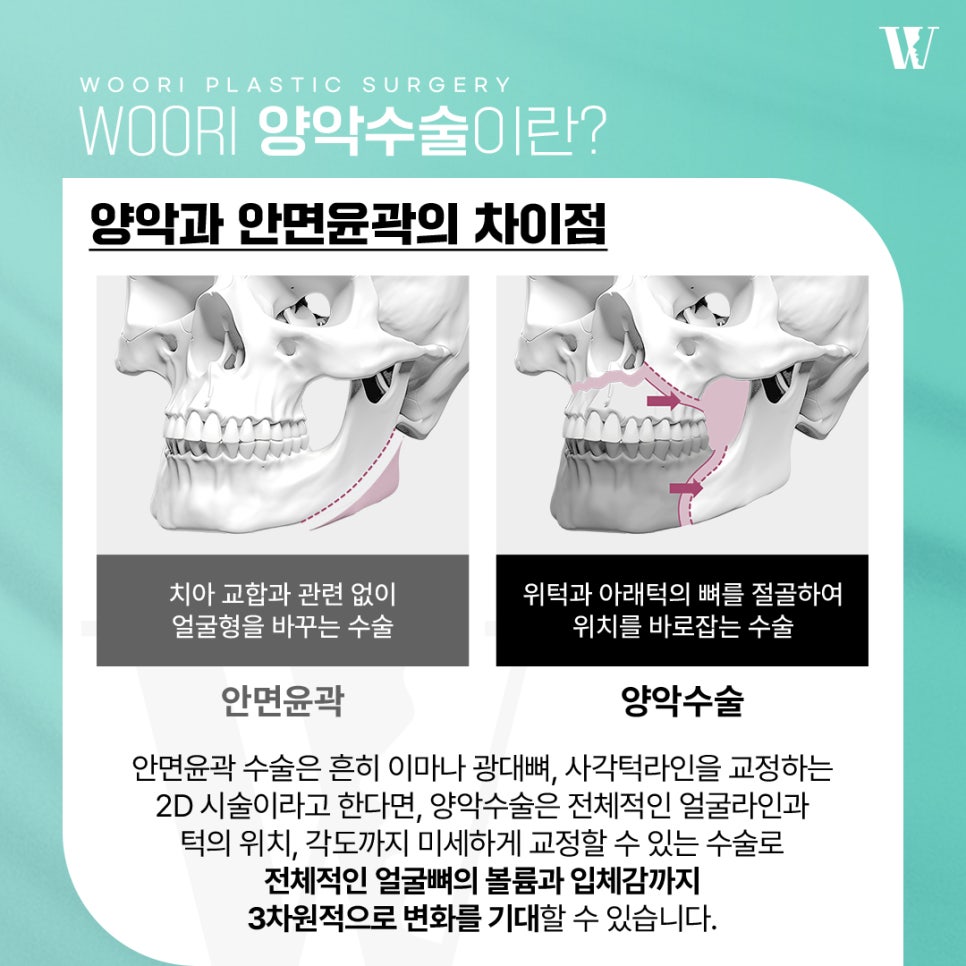 양악수술 안면윤곽과 무엇이 다를까? 관련 이미지 2