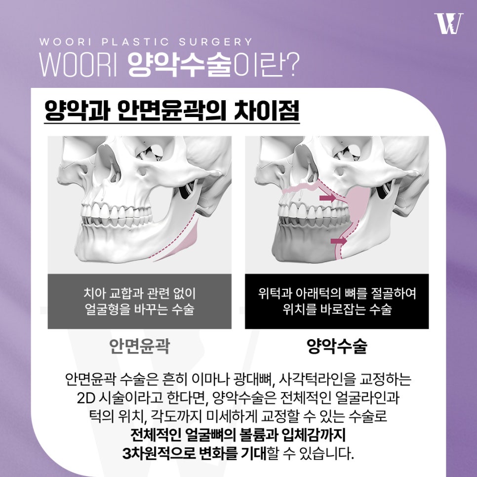 양악수술후기 외모보다 기능 변화가 만족스러운 이유 관련 이미지 2