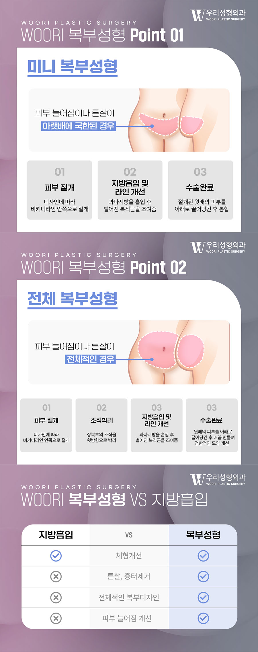 복부지방흡입 비용 확인해볼까 관련 이미지 2