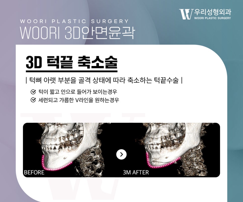 안면윤곽수술 3종을 모두 해야 얼굴형이 자연스러워질까요? 관련 이미지 4