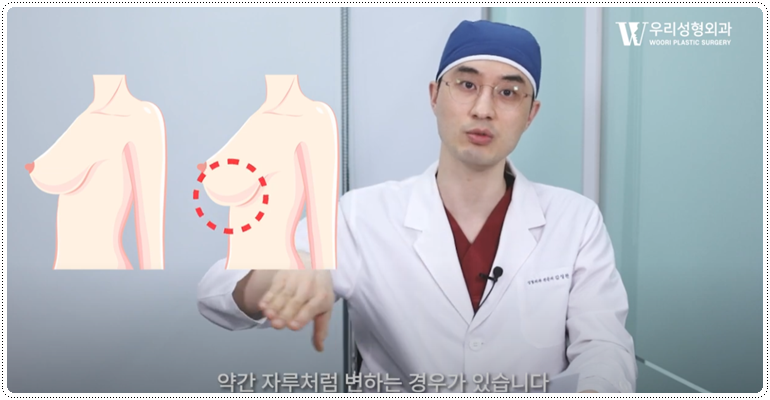 가슴축소 후기 재수술 하지 않으려면 관련 이미지 3