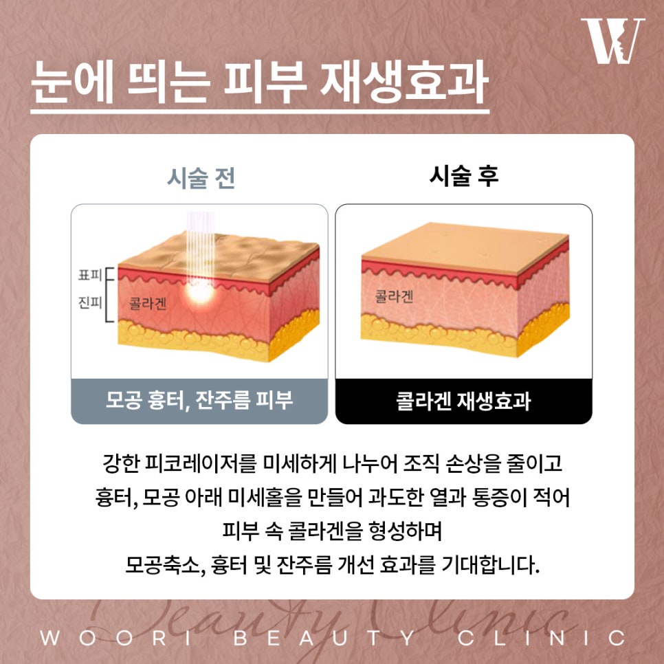 Laser Toning for Melasma and Blemishes image 4