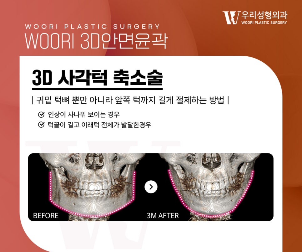 Cheekbone Reduction: Will Reducing Only the Lateral Cheekbones Make the Face Look Smaller? image 3