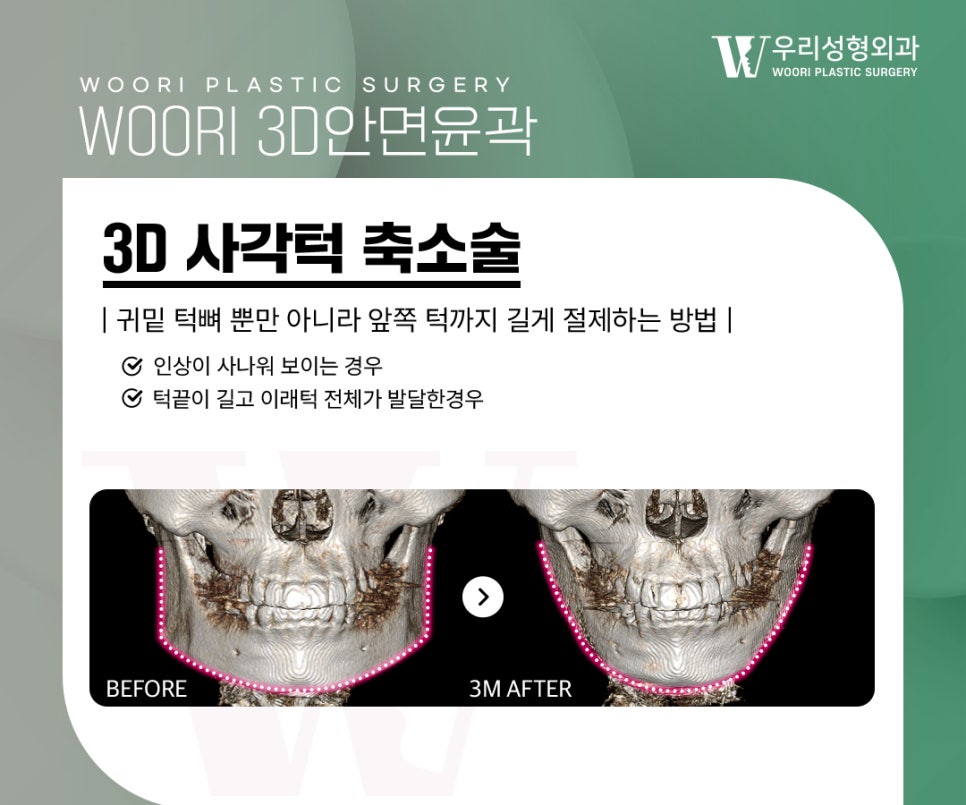 Why Does Facial Width Decrease After Contouring Surgery? image 3