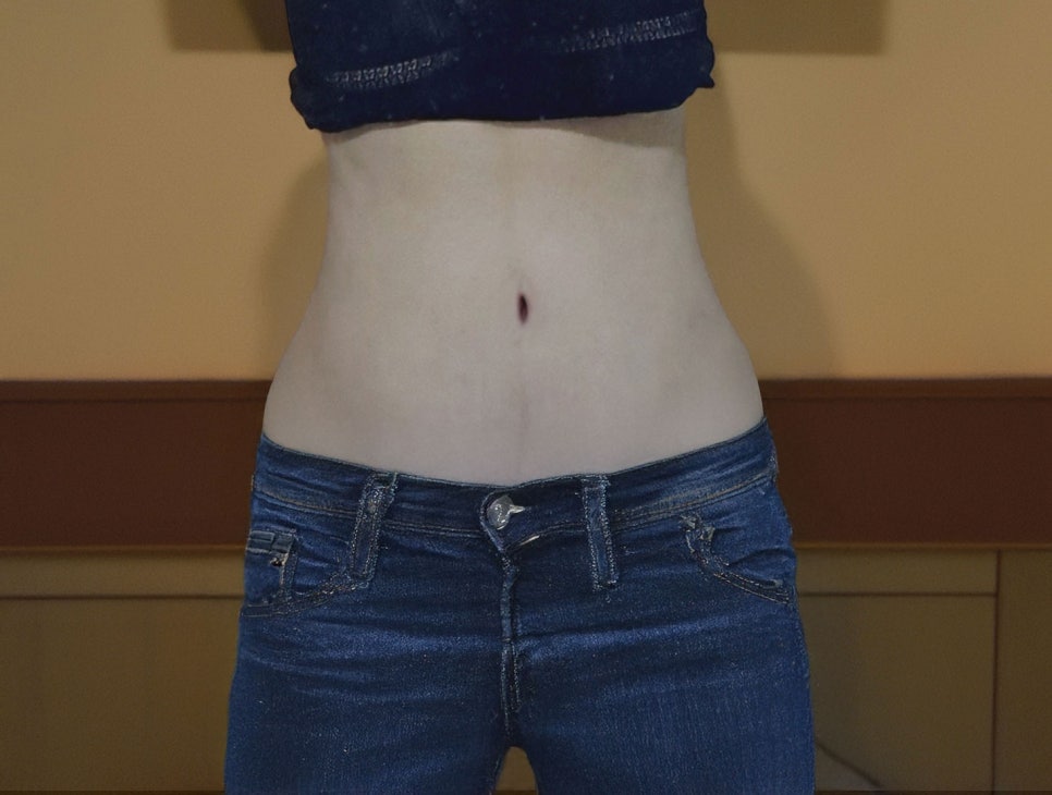 복부지방흡입 비용 확인해볼까 관련 이미지 8