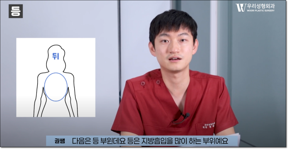 상체지방흡입 효과 한눈에 알아보기 관련 이미지 5