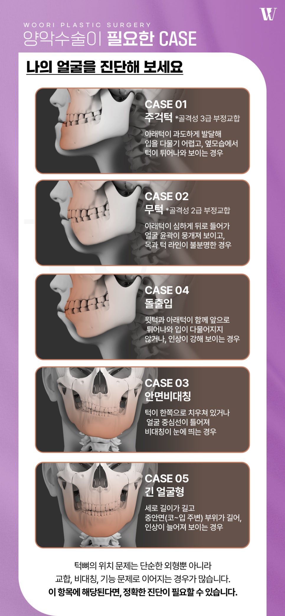 주걱턱수술 전 체크해야 할 얼굴 유형과 변화 방향 관련 이미지 2