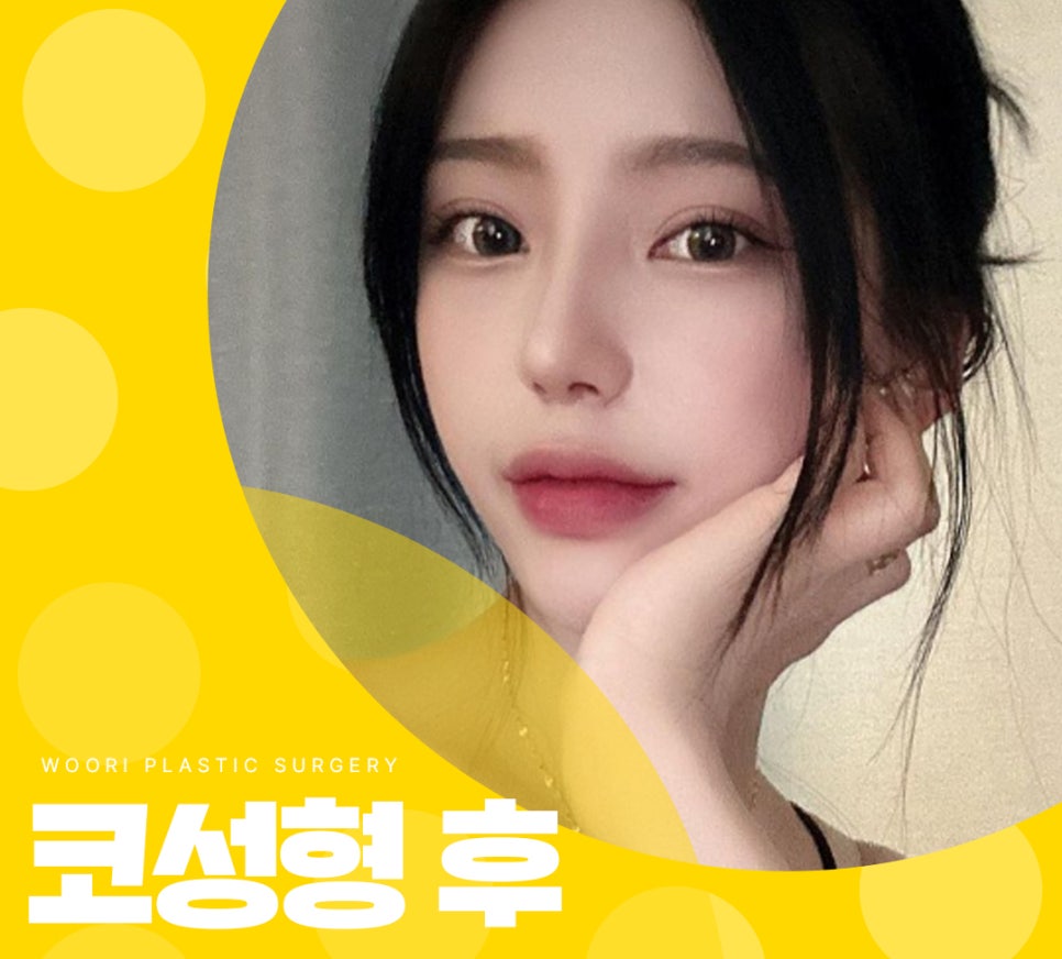 코성형 후 붓기 , 부작용 , 염증 치료를 위한 코성형 후기 관련 이미지 2
