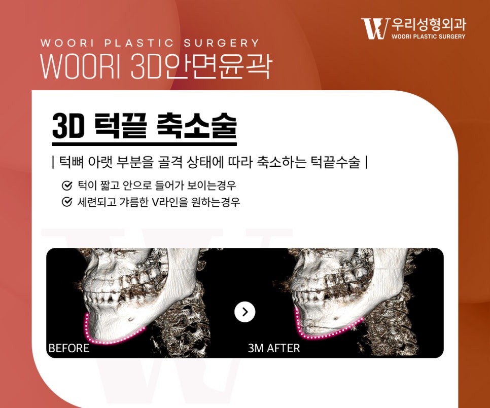 Cheekbone Reduction: Will Reducing Only the Lateral Cheekbones Make the Face Look Smaller? image 4