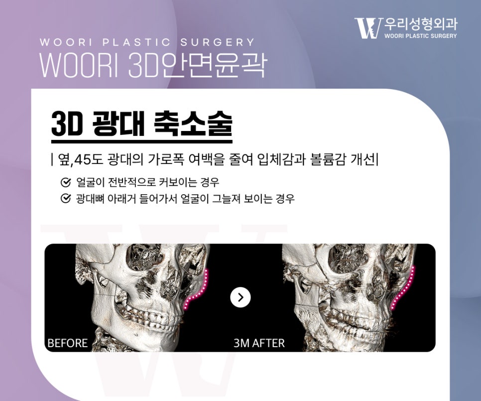턱끝수술 안면윤곽 3종과 함께 하는 이유는 무엇일까? 관련 이미지 2