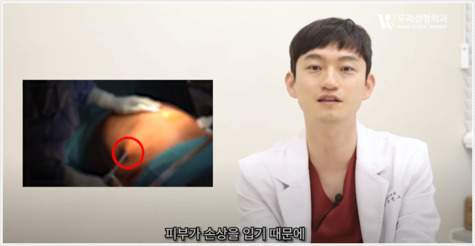 지방흡입 흉터치료 관리 꿀팁 관련 이미지 4