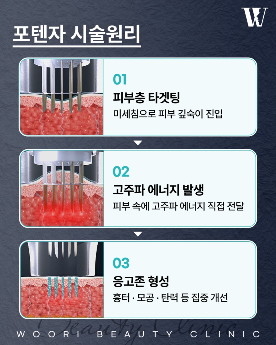 모공포텐자 이런 피부라면 효과를 기대할 수 있습니다 관련 이미지 3