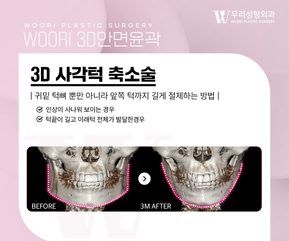 Key Points of Facial Contouring Surgery for Improving the Cheekbone Line image 4