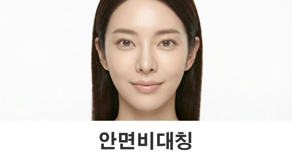 When Is Double Jaw Surgery Needed for Facial Asymmetry? image 1