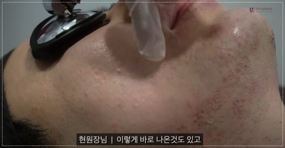 수염 레이저제모 주기 젠틀프로맥스 알아보기 관련 이미지 3