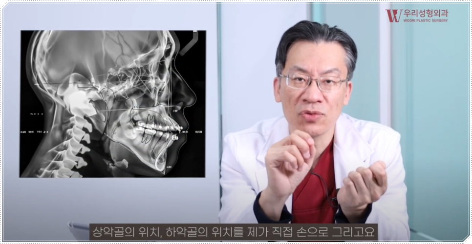 양악수술방법 이렇게 진행돼요 관련 이미지 5