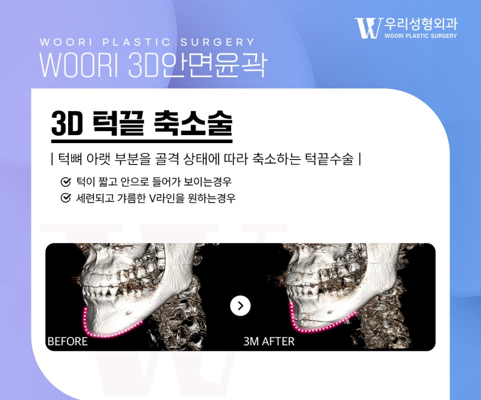 안면윤곽수술 얼굴 라인과 비율을 함께 보는 이유 관련 이미지 5