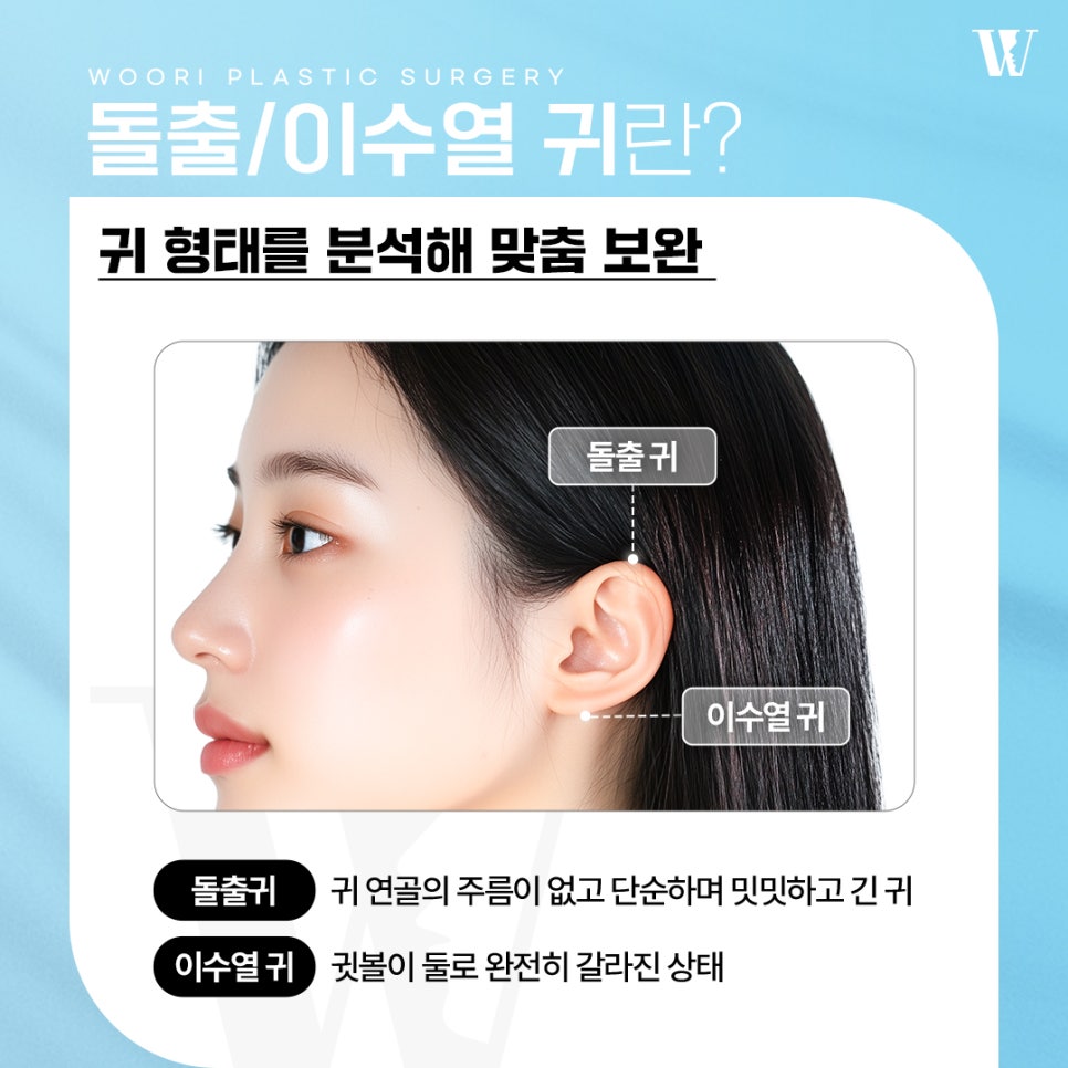 귀성형 귀 각도와 비율로 달라지는 인상 변화 관련 이미지 2