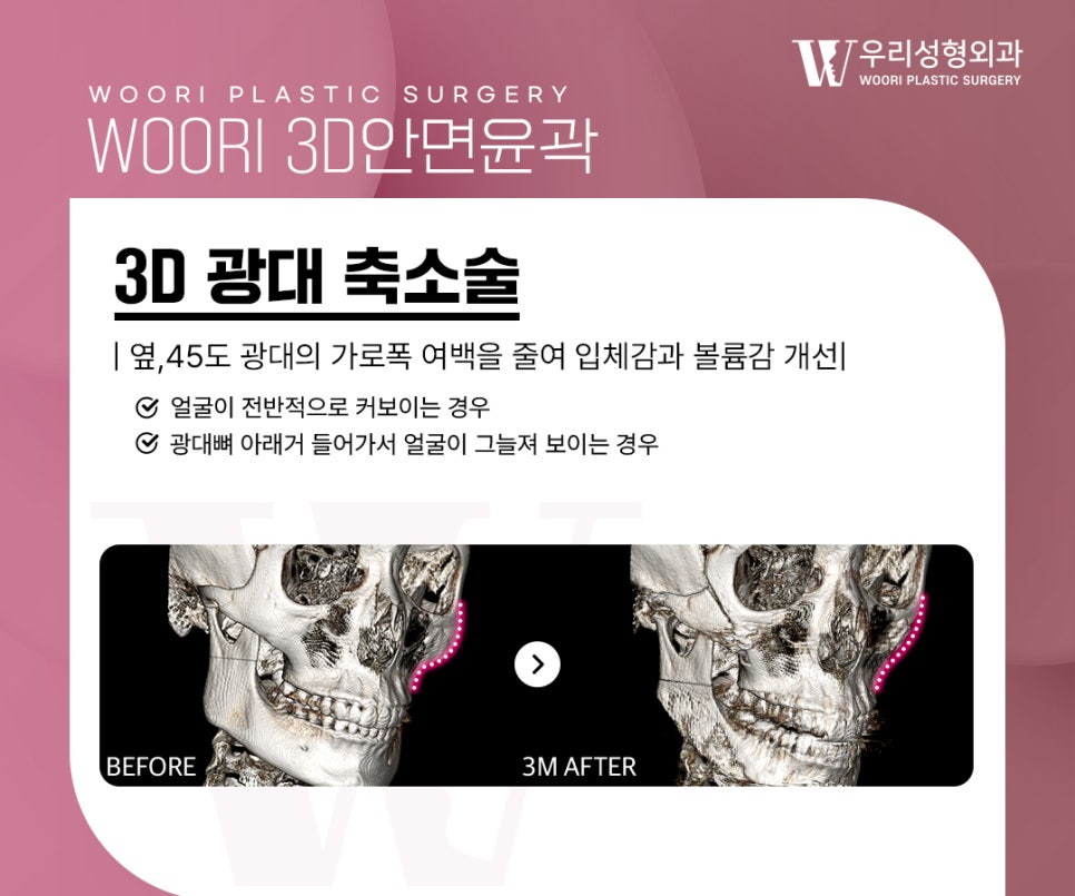 안면윤곽 수술 어떤 차이가 있을까 관련 이미지 3