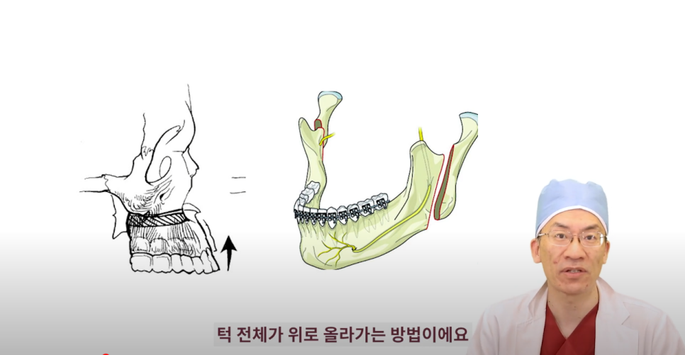 우리성형외과 임평진 원장 긴 얼굴 어떻게 줄일까?! 얼굴 짧아지는 2가지 방법! 관련 이미지 4