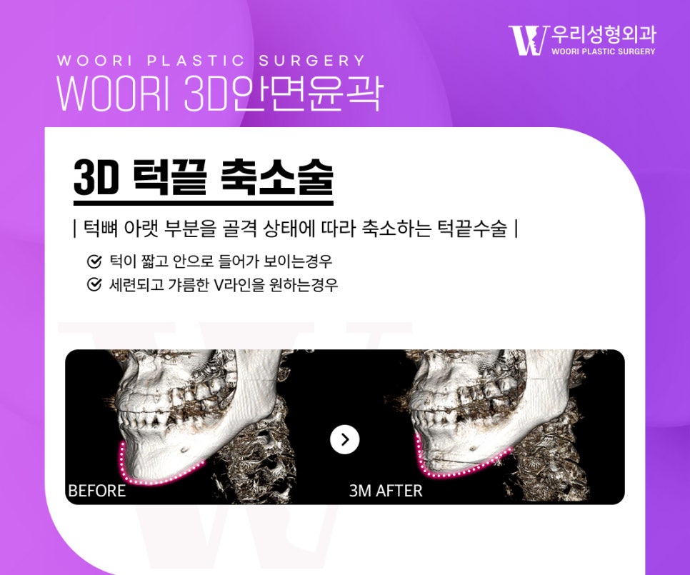 윤곽3종 한 가지 수술만으로는 부족한 이유 관련 이미지 4