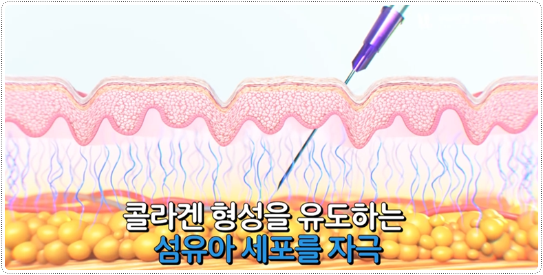 쥬베룩볼륨 효과 언제부터 나타날까요 관련 이미지 2