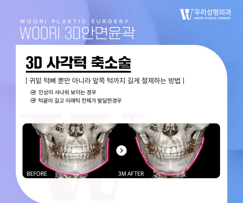안면윤곽수술 얼굴 라인과 비율을 함께 보는 이유 관련 이미지 3