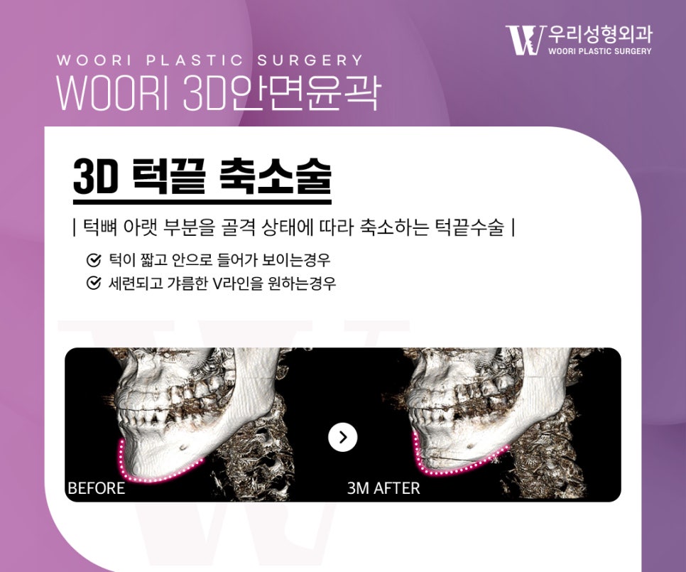 사각턱수술 함께 고려되는 윤곽 라인 개선 관련 이미지 4