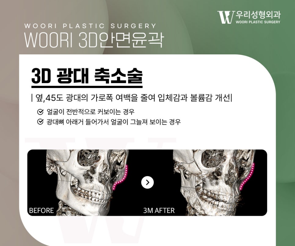 안면윤곽수술 이런 얼굴형이라면 고려해볼 수 있어요 관련 이미지 3