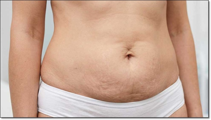 복부거상술 미니복부거상 차이 정리 관련 이미지 2